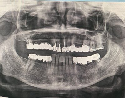 Grafi Dentare Skaner 3D GALERIA operon ne treg që nga viti 2015, te parët që sollëm teknonogjinë e fundit te Skaner CBCT, Grafi Dentare Tirane